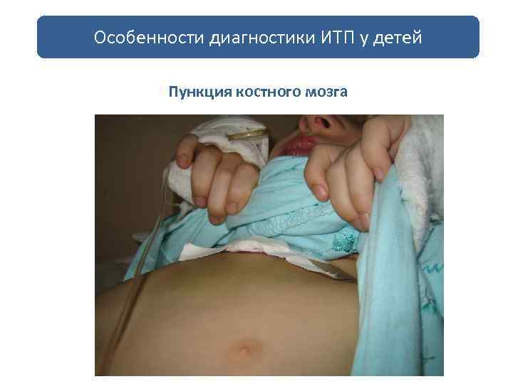 Особенности диагностики ИТП у детей Пункция костного мозга Всегда под наркозом Минимум 2 точки
