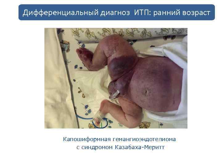 Дифференциальный диагноз ИТП: ранний возраст Капошиформная гемангиоэндотелиома с синдромом Казабаха-Меритт 