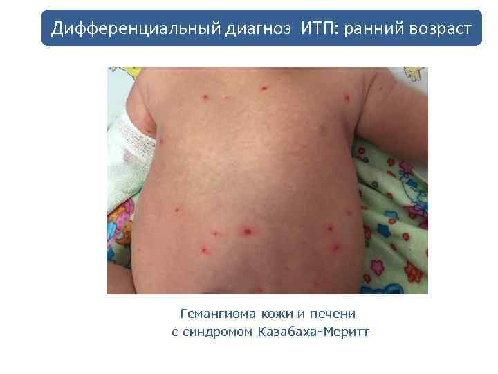 Дифференциальный диагноз ИТП: ранний возраст Гемангиома кожи и печени с синдромом Казабаха-Меритт 