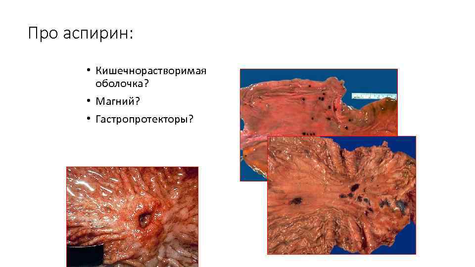 Про аспирин: • Кишечнорастворимая оболочка? • Магний? • Гастропротекторы? 