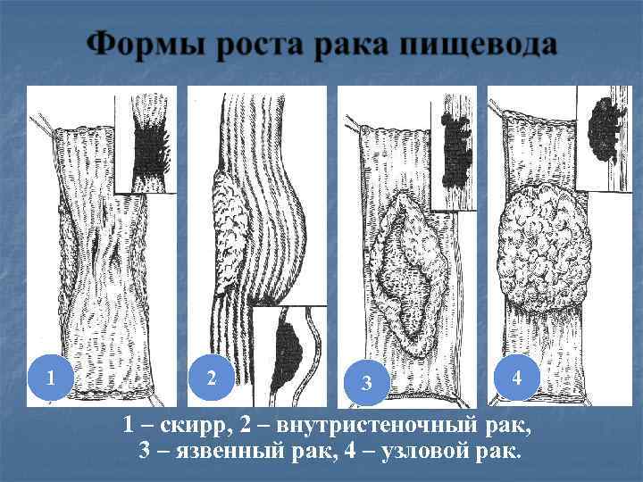 1 2 3 4 1 – скирр, 2 – внутристеночный рак, 3 – язвенный