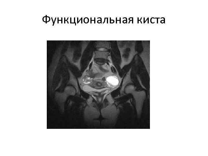 Функциональная киста 