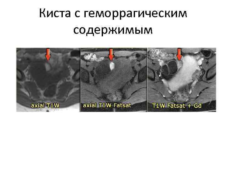 Киста с геморрагическим содержимым 