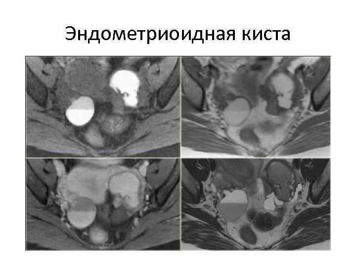 Эндометриоидная киста 