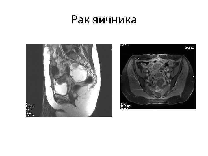 Рак яичника 