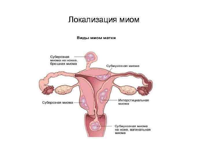 Локализация миом 