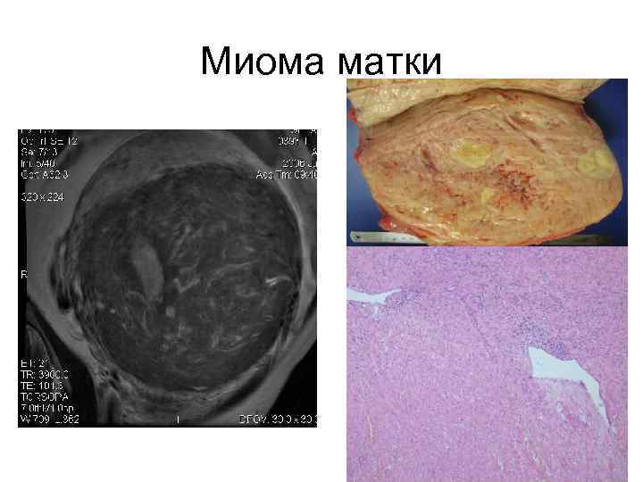 Миома матки 