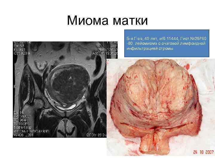 Миома матки Б-я Г-ва, 45 лет, и/б 11444, Гист. № 29760 -80: лейомиома с