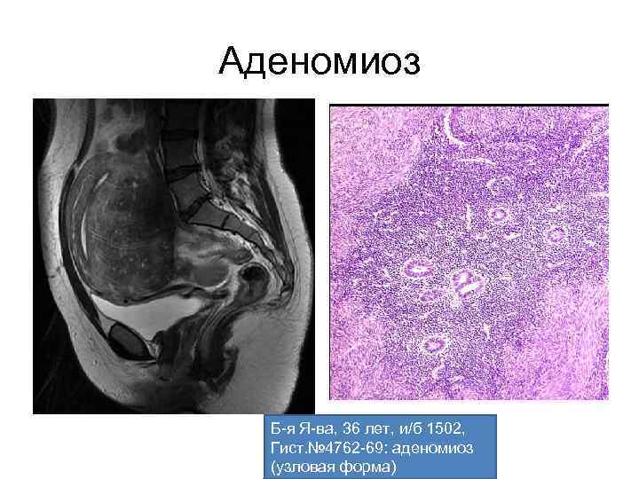 Аденомиоз Б-я Я-ва, 36 лет, и/б 1502, Гист. № 4762 -69: аденомиоз (узловая форма)