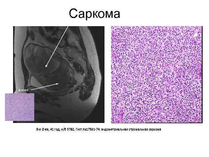 Саркома миома Б-я О-ва, 41 год, и/б 5782, Гист. № 17631 -74: эндометриальная стромальная