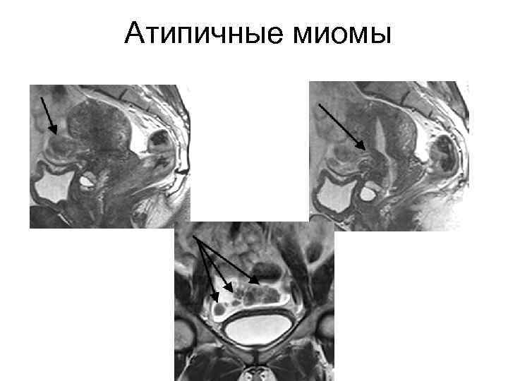 Атипичные миомы 