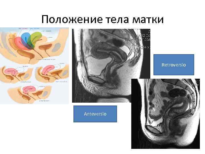 Положение тела матки Retroversio Anteversio 