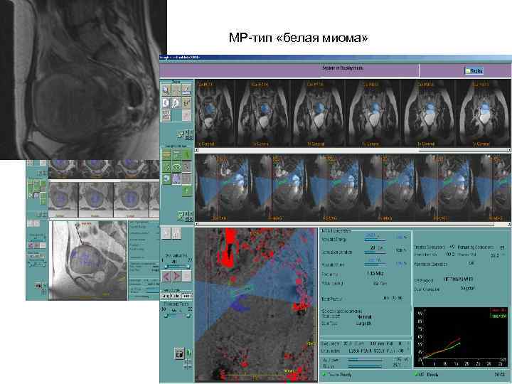 МР-тип «белая миома» 