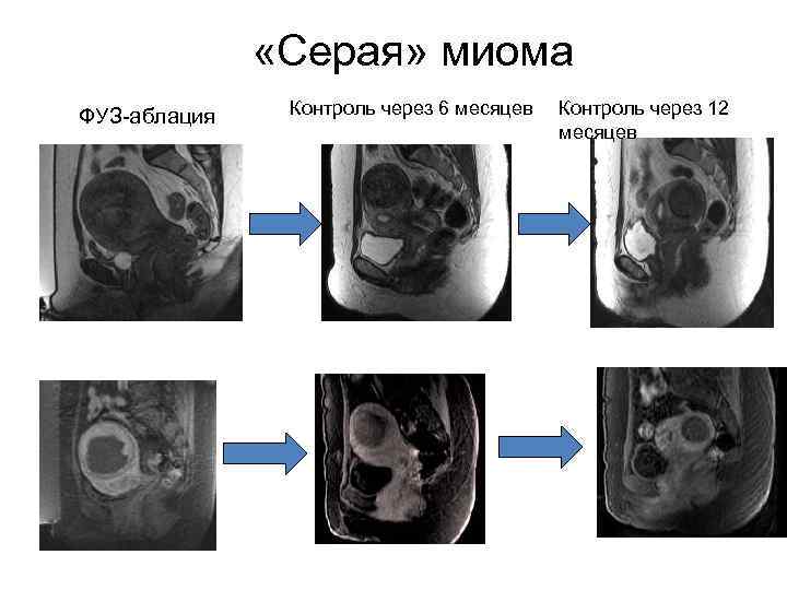  «Серая» миома ФУЗ-аблация Контроль через 6 месяцев Контроль через 12 месяцев 