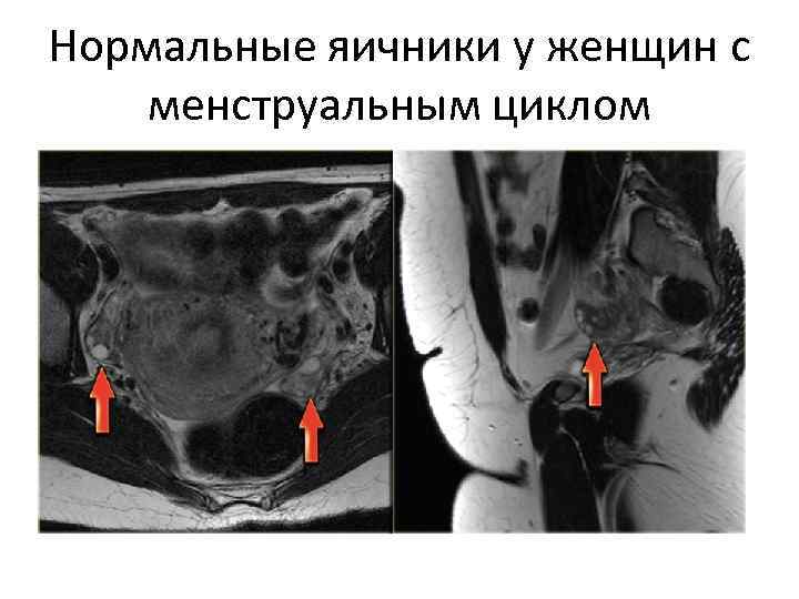 Фото как расположены яичники у женщин