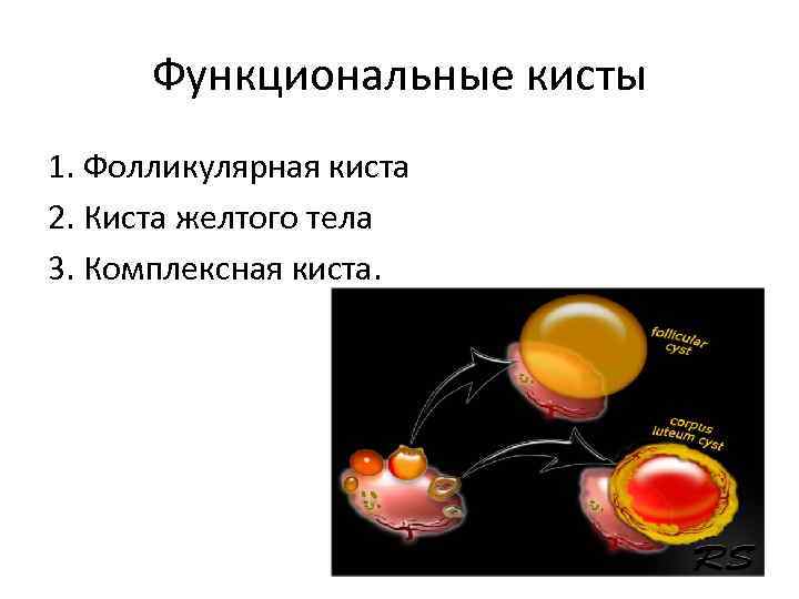 Функциональные кисты 1. Фолликулярная киста 2. Киста желтого тела 3. Комплексная киста. 