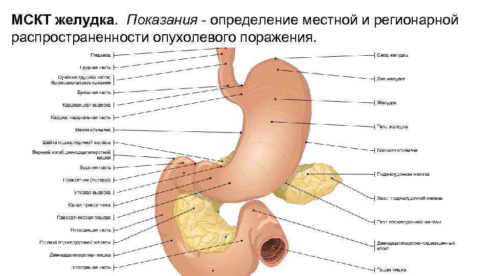 МСКТ желудка. Показания - определение местной и регионарной распространенности опухолевого поражения. 