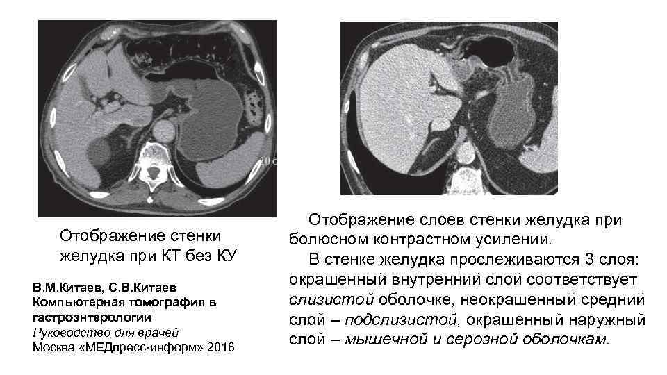 Отображение стенки желудка при КТ без КУ В. М. Китаев, С. В. Китаев Компьютерная