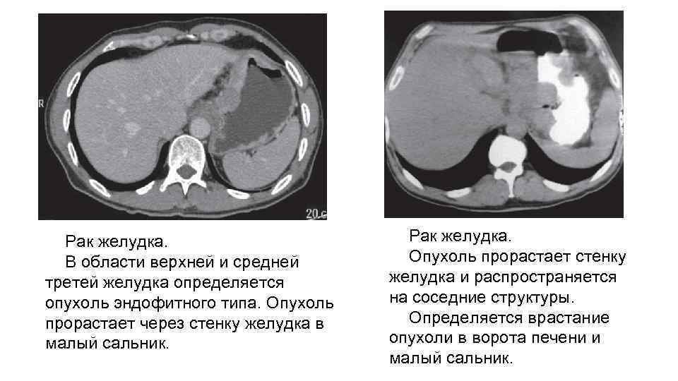 Рак желудка. В области верхней и средней третей желудка определяется опухоль эндофитного типа. Опухоль