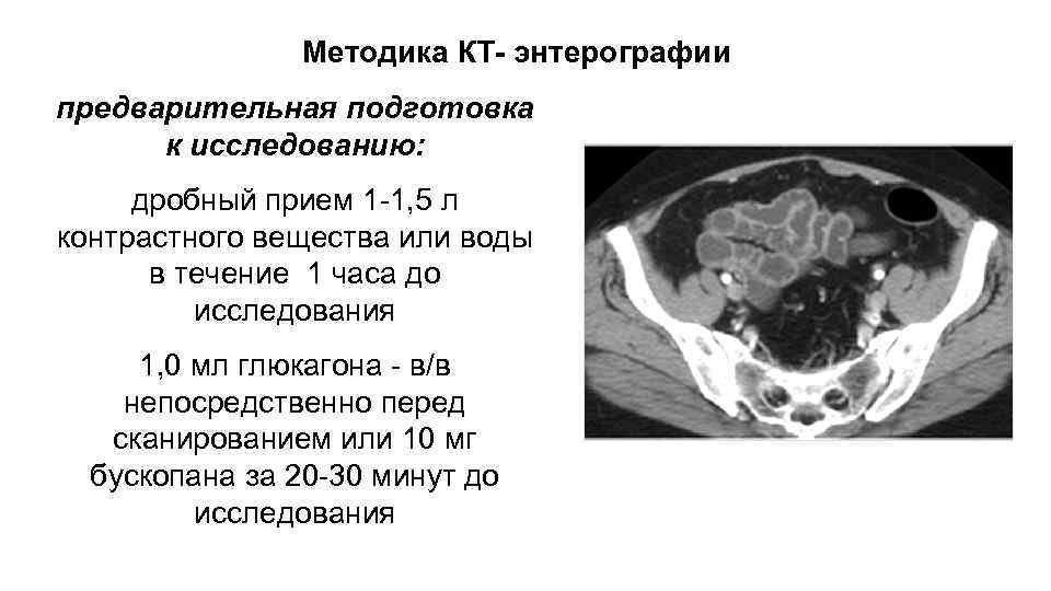 Методика КТ- энтерографии предварительная подготовка к исследованию: дробный прием 1 -1, 5 л контрастного