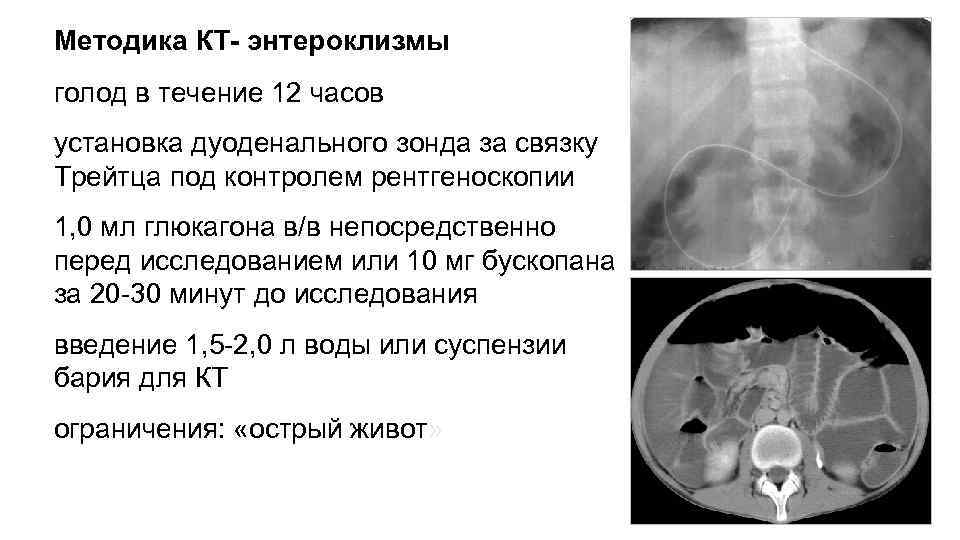 Методика КТ- энтероклизмы голод в течение 12 часов установка дуоденального зонда за связку Трейтца