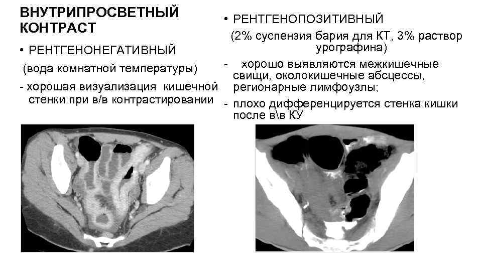 ВНУТРИПРОСВЕТНЫЙ КОНТРАСТ • РЕНТГЕНОПОЗИТИВНЫЙ (2% суспензия бария для КТ, 3% раствор урографина) • РЕНТГЕНОНЕГАТИВНЫЙ