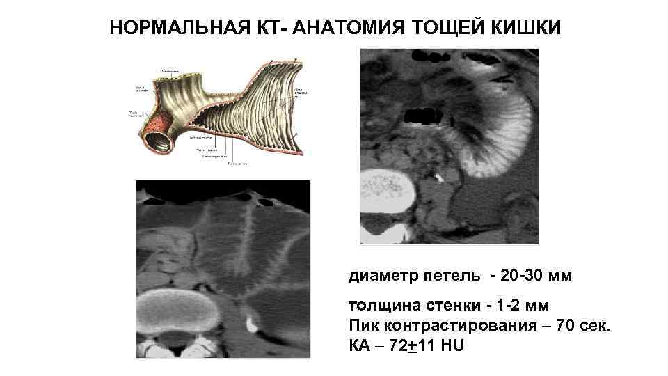 НОРМАЛЬНАЯ КТ- АНАТОМИЯ ТОЩЕЙ КИШКИ диаметр петель - 20 -30 мм толщина стенки -