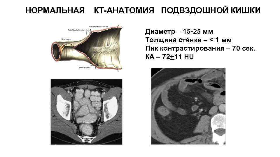 НОРМАЛЬНАЯ КТ-АНАТОМИЯ ПОДВЗДОШНОЙ КИШКИ Диаметр – 15 -25 мм Толщина стенки – < 1