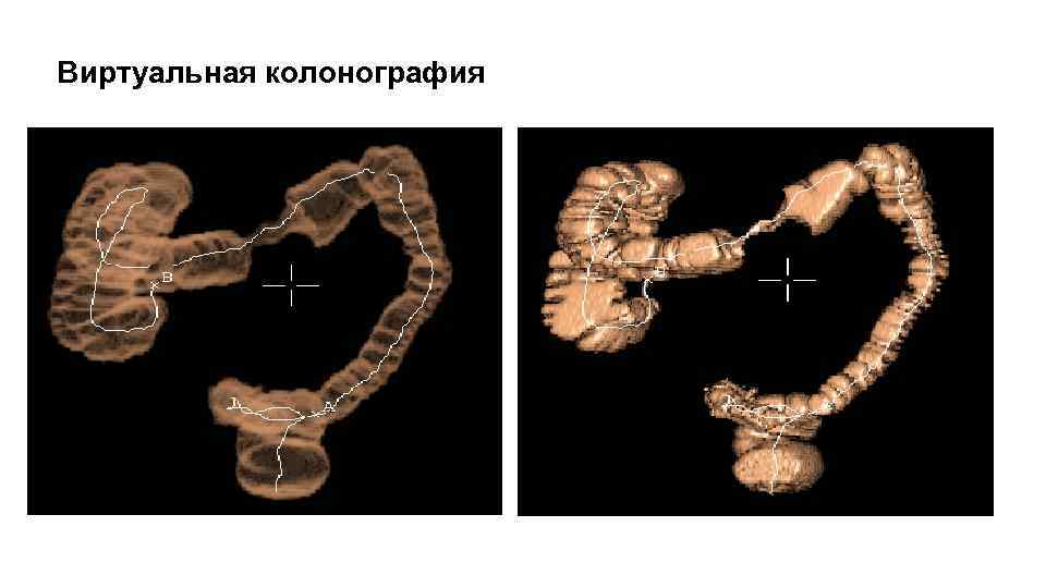 Виртуальная колонография 