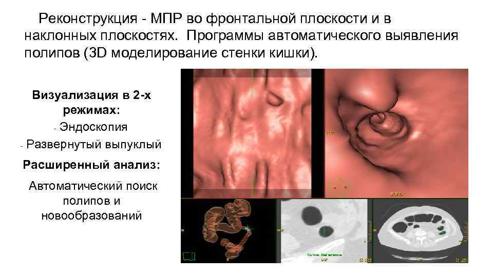 Реконструкция - МПР во фронтальной плоскости и в наклонных плоскостях. Программы автоматического выявления полипов