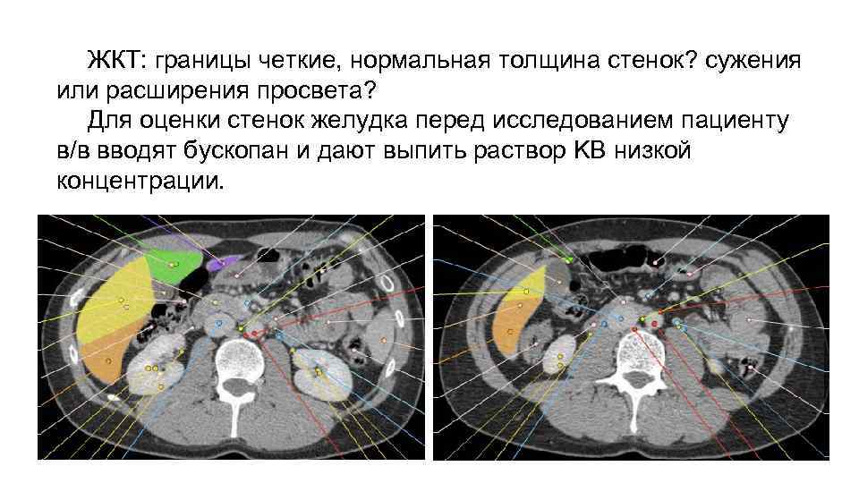 ЖКТ: границы четкие, нормальная толщина стенок? сужения или расширения просвета? Для оценки стенок желудка