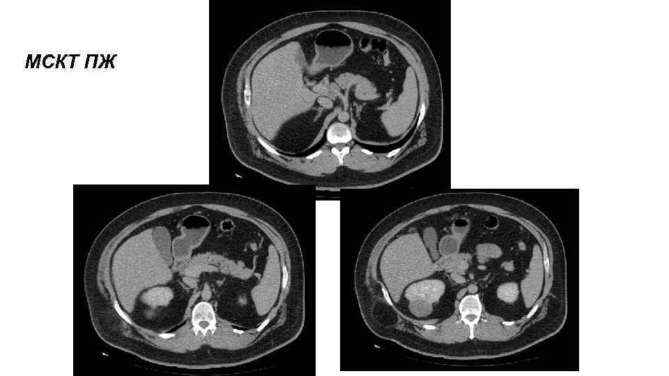 МСКТ ПЖ 