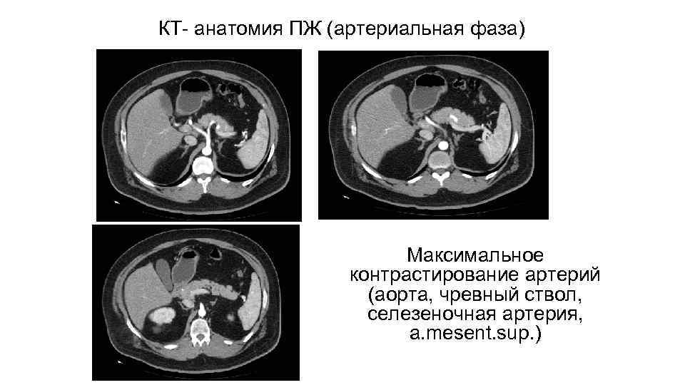 КТ- анатомия ПЖ (артериальная фаза) Максимальное контрастирование артерий (аорта, чревный ствол, селезеночная артерия, a.