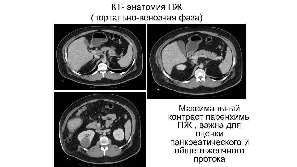 КТ- анатомия ПЖ (портально-венозная фаза) Максимальный контраст паренхимы ПЖ , важна для оценки панкреатического