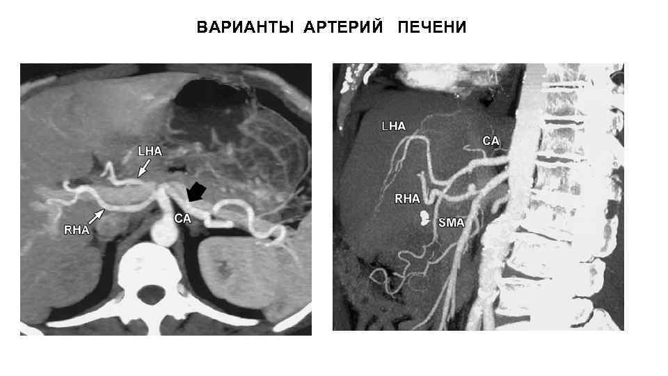 ВАРИАНТЫ АРТЕРИЙ ПЕЧЕНИ 