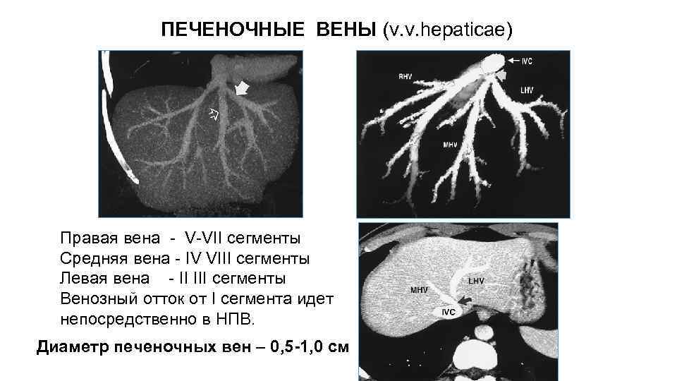 ПЕЧЕНОЧНЫЕ ВЕНЫ (v. v. hepaticae) Правая вена - V-VII сегменты Средняя вена - IV