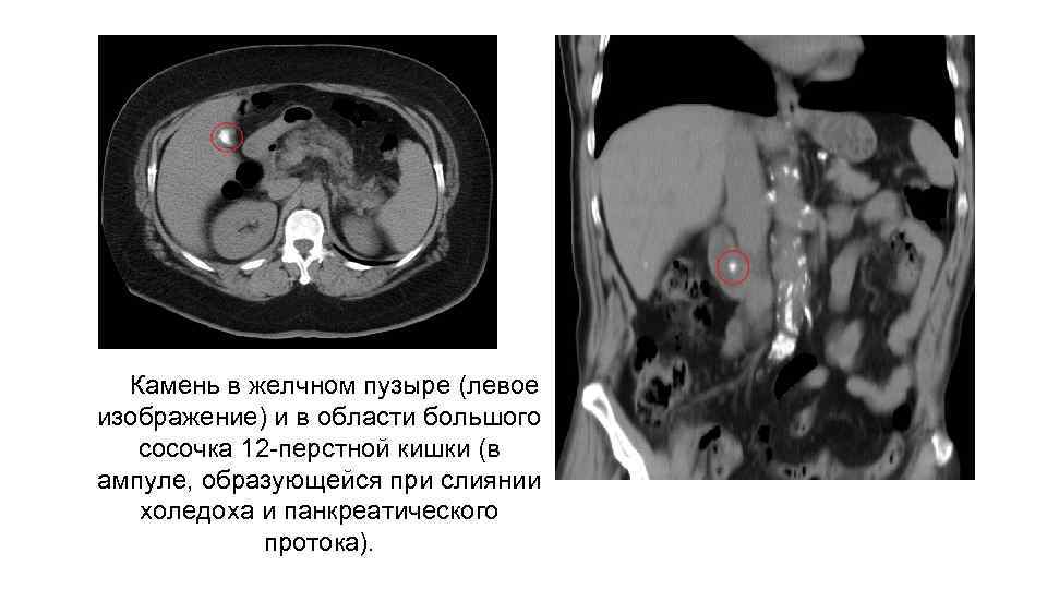Камень в желчном пузыре (левое изображение) и в области большого сосочка 12 -перстной кишки