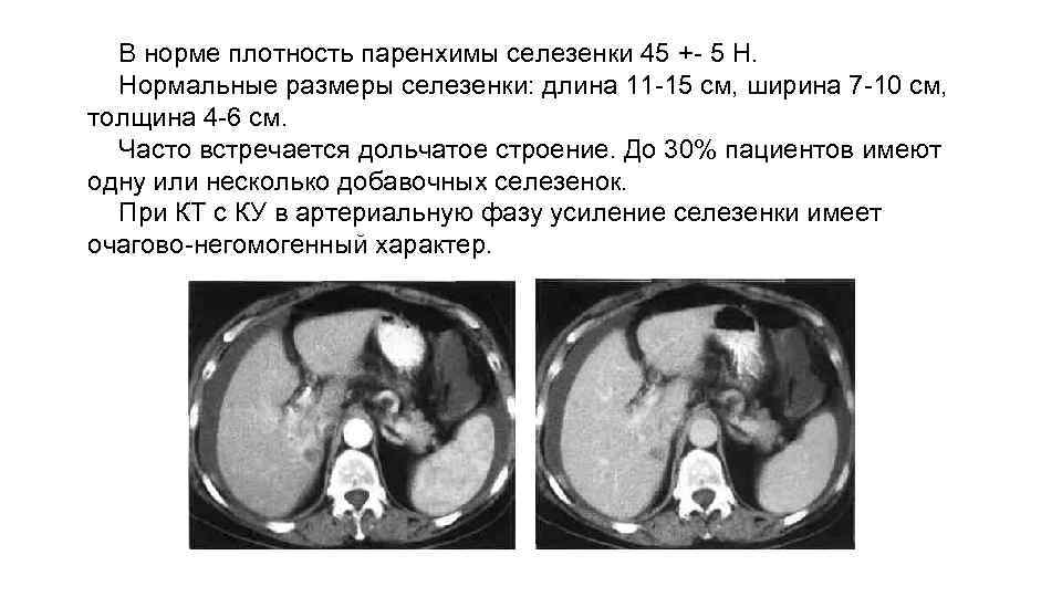 В норме плотность паренхимы селезенки 45 +- 5 Н. Нормальные размеры селезенки: длина 11