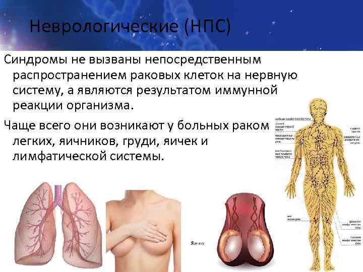 Неврологические (НПС) Синдромы не вызваны непосредственным распространением раковых клеток на нервную систему, а являются