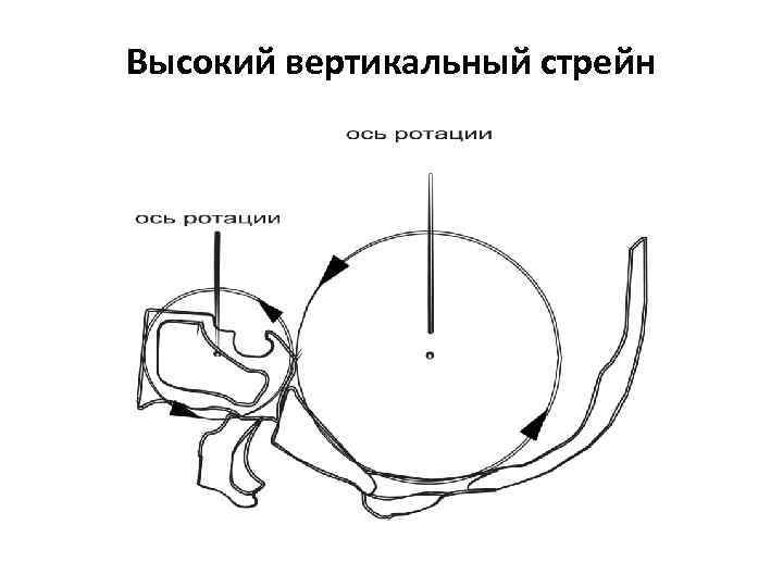 Высокий вертикальный стрейн 