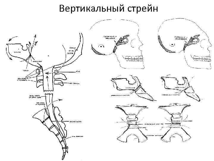 Вертикальный стрейн 