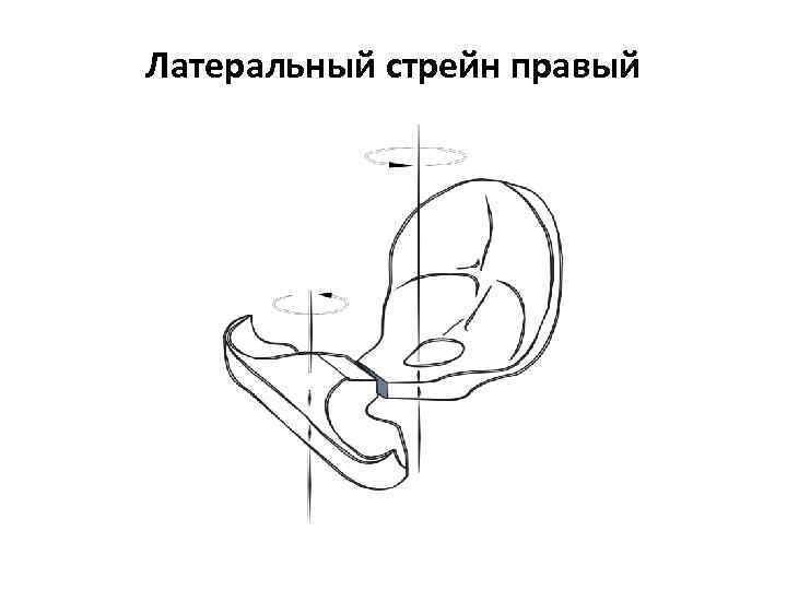 Латеральный стрейн правый 