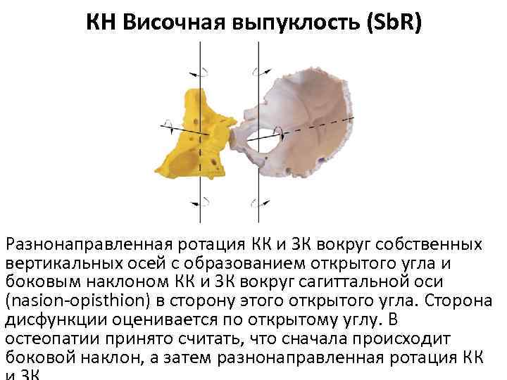 КН Височная выпуклость (Sb. R) Разнонаправленная ротация КК и ЗК вокруг собственных вертикальных осей