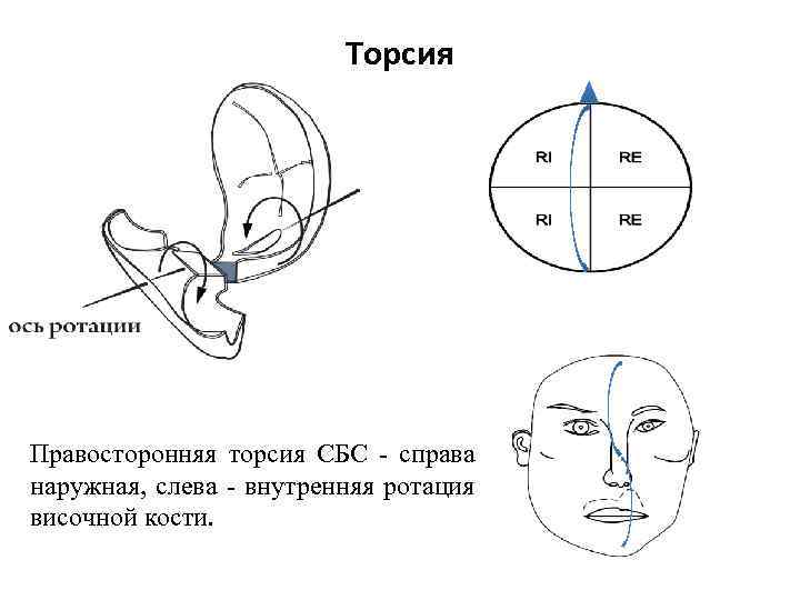 Торсия Правосторонняя торсия СБС справа наружная, слева внутренняя ротация височной кости. 