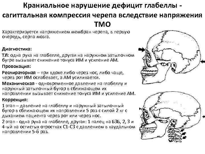 Краниальное нарушение дефицит глабеллы - сагиттальная компрессия черепа вследствие напряжения ТМО Характеризуется напряжением мембран