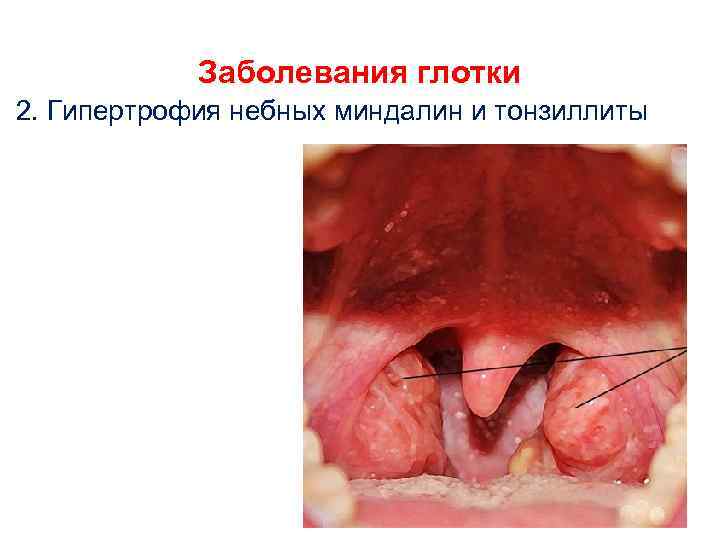 Заболевания глотки 2. Гипертрофия небных миндалин и тонзиллиты 
