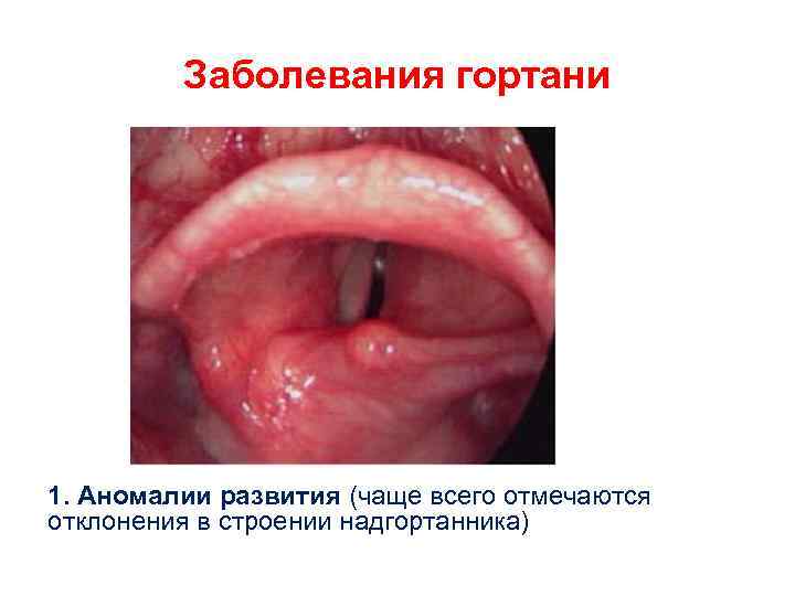 Заболевания гортани 1. Аномалии развития (чаще всего отмечаются отклонения в строении надгортанника) 