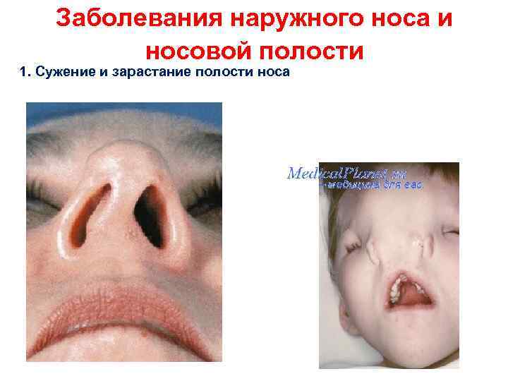 Заболевания наружного носа и носовой полости 1. Сужение и зарастание полости носа 