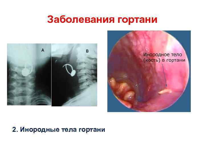 Заболевания гортани 2. Инородные тела гортани 
