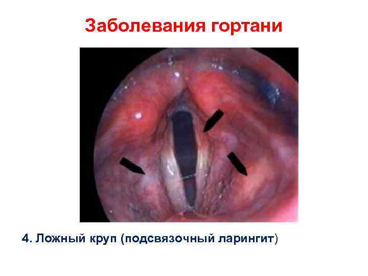 Заболевания гортани 4. Ложный круп (подсвязочный ларингит) 